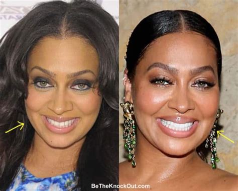 did lala anthony have plastic surgery